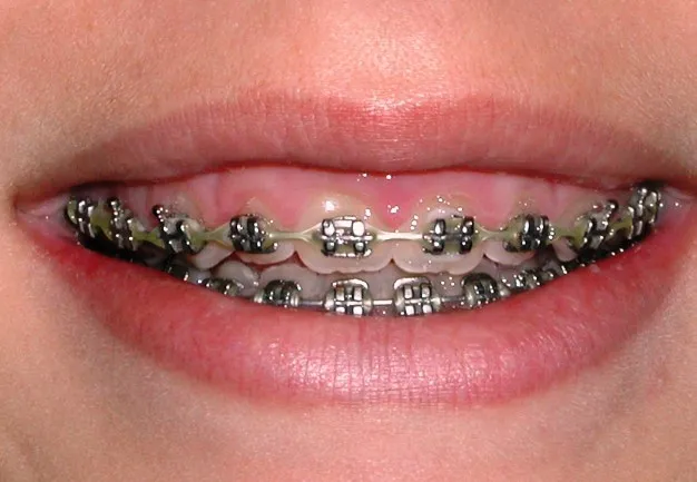 Crown lengthening - before treatment