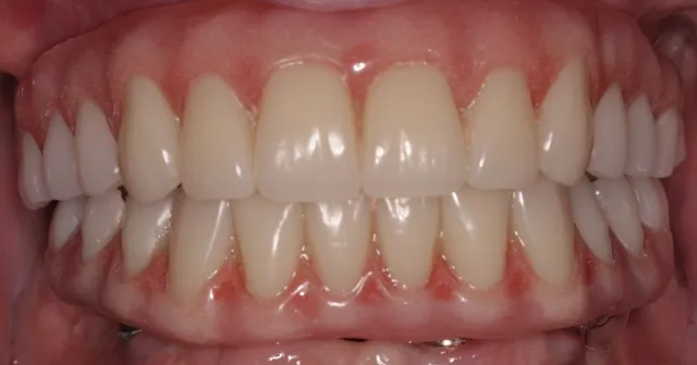 Patient with decayed teeth - after dental implants, front view