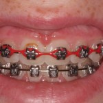Crown lengthening - before procedure