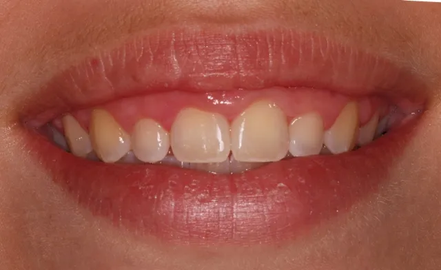 Crown lengthening - before