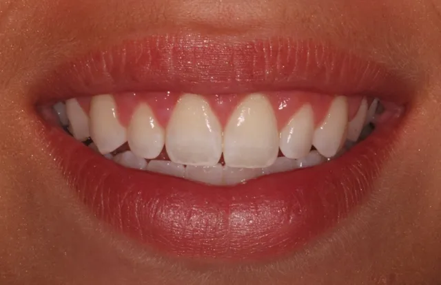 Crown lengthening - after