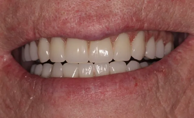 Patient with decayed teeth - after dental implants, smile
