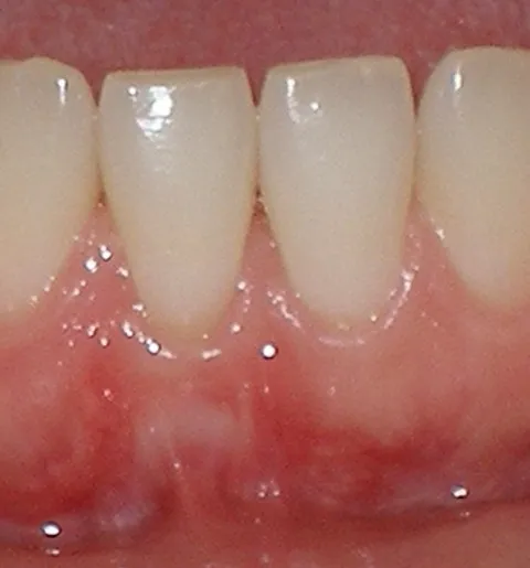 Gum graft - after