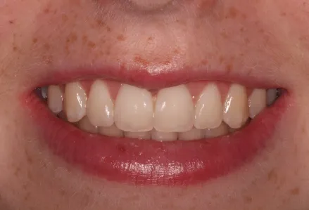 Crown lengthening - after procedure