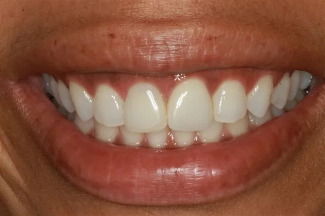 Patient with fractured tooth - after