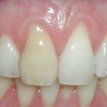 Gum grafting - before