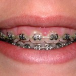Crown lengthening - before treatment