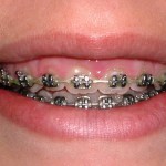 Crown lengthening - before treatment