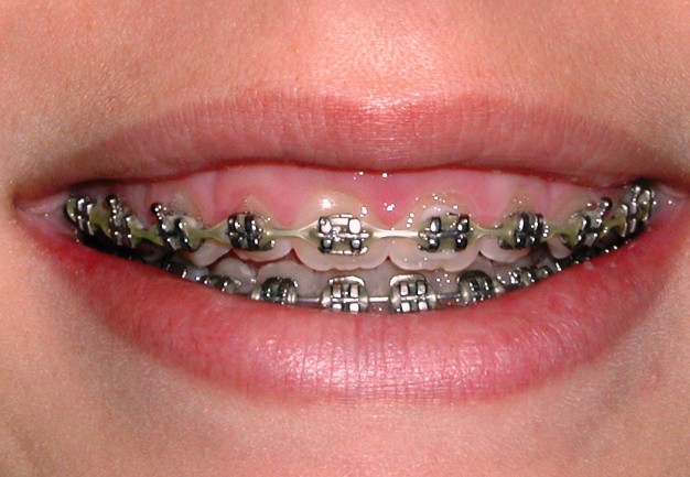 Crown lengthening - before treatment
