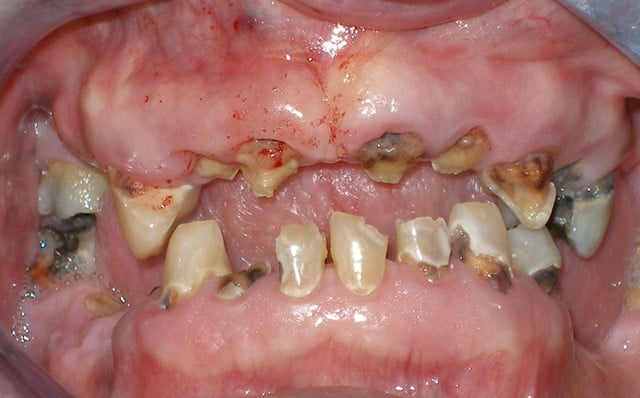 Patient with decayed teeth - before dental implants