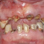 Patient with decayed teeth - before dental implants