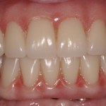 Patient with decayed teeth - after dental implants, front view