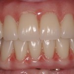 Patient with decayed teeth - after dental implants, front view