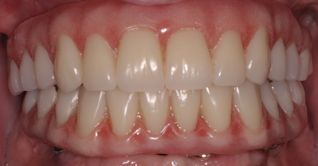 Patient with decayed teeth - after dental implants, front view