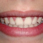 Crown lengthening - after treatment