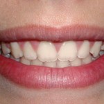 Crown lengthening - after treatment