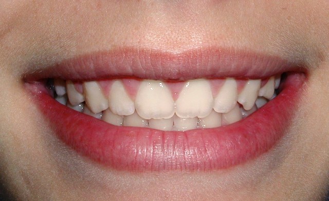 Crown lengthening - after treatment