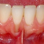 Gum graft - before
