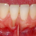 Gum graft - before