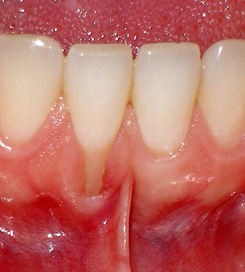 Gum graft - before