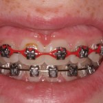 Crown lengthening - before procedure