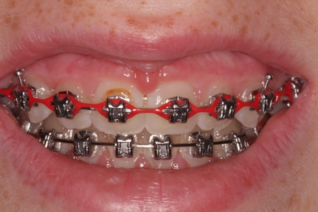 Crown lengthening - before procedure