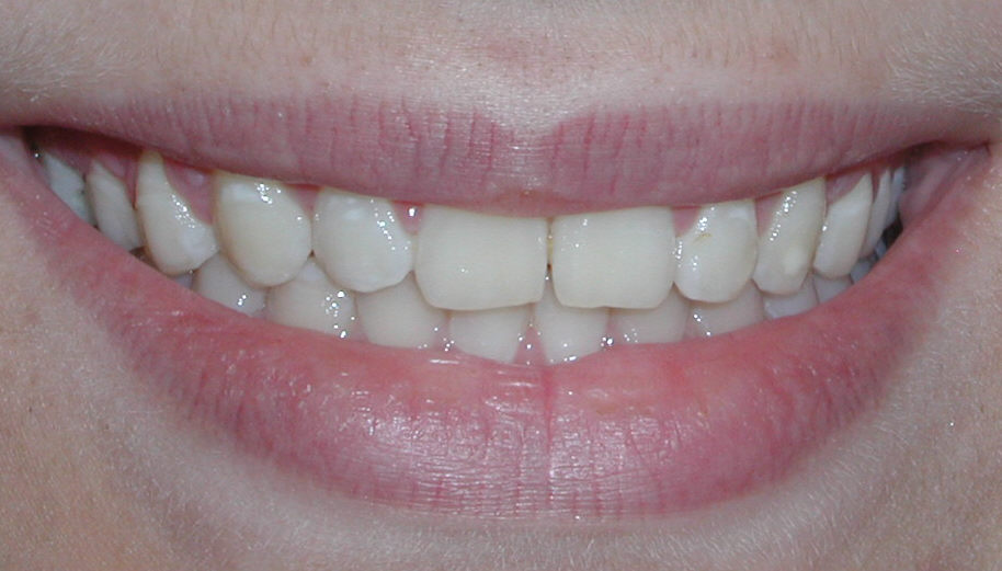 Crown lengthening - after