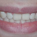 Crown lengthening - after
