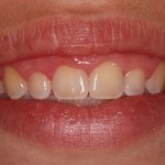 Crown lengthening - before