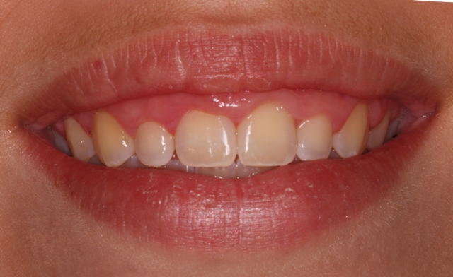 Crown lengthening - before