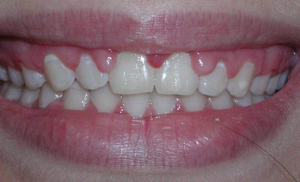 Crown lengthening - before