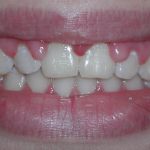 Crown lengthening - before