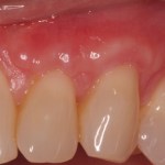 Gum graft - after procedure