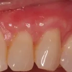 Gum graft - after procedure