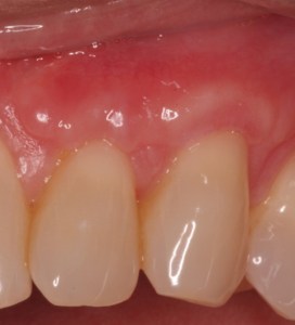 Gum graft - after procedure