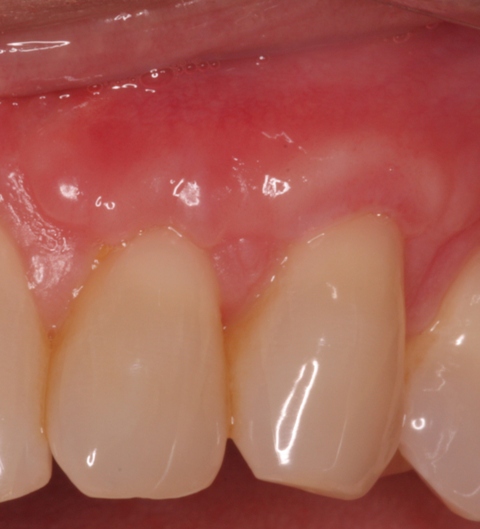 Gum graft - after procedure