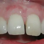 Gum graft - after treatment