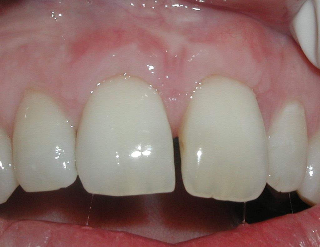 Gum graft - after treatment