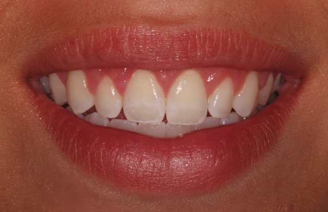 Crown lengthening - after