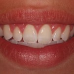 Crown lengthening - after