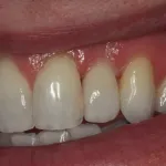 Patient with failed tooth - after