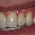 Patient with failed tooth - after