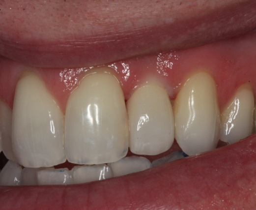 Patient with failed tooth - after
