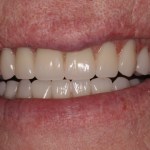 Patient with decayed teeth - after dental implants, smile