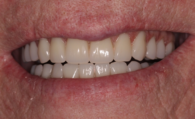 Patient with decayed teeth - after dental implants, smile
