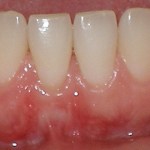 Gum graft - after