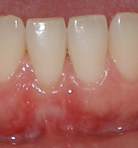 Gum graft - after