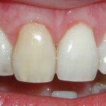 Gum grafting - after