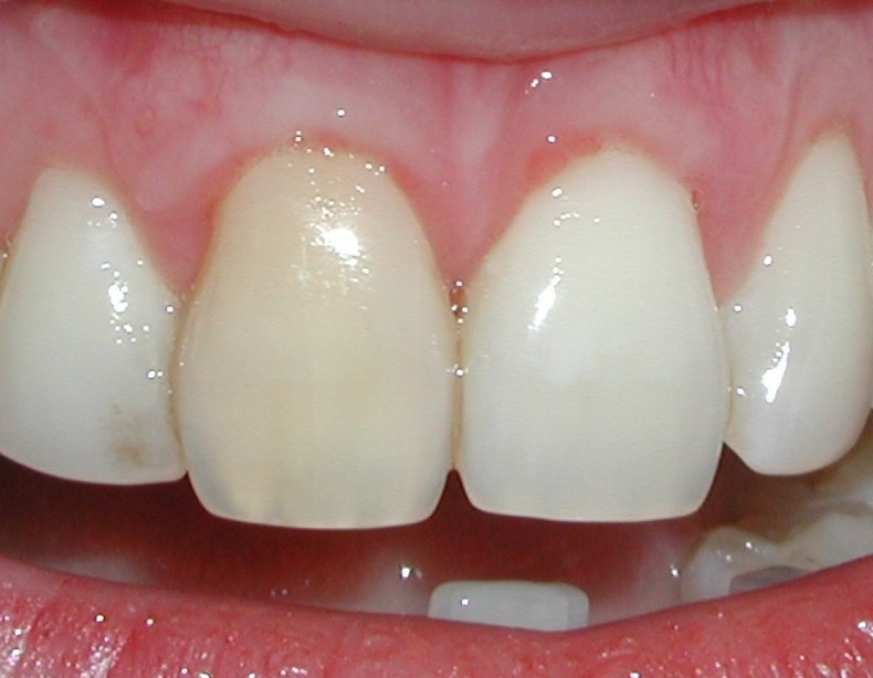 Gum grafting - after