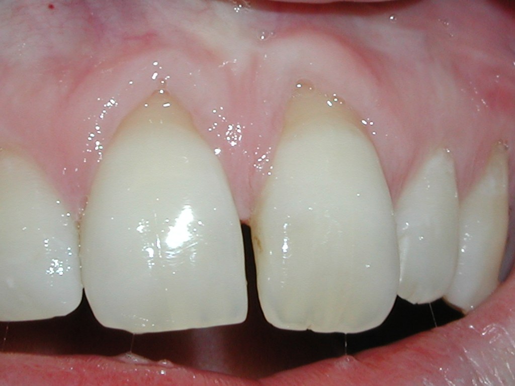 Gum graft - before treatment